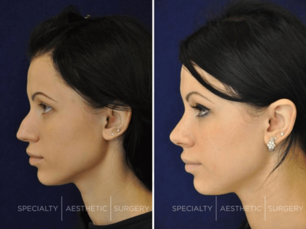 How Long Is Recovery From a Nose Job?