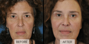 How Can I Lift Sagging Jowls?
