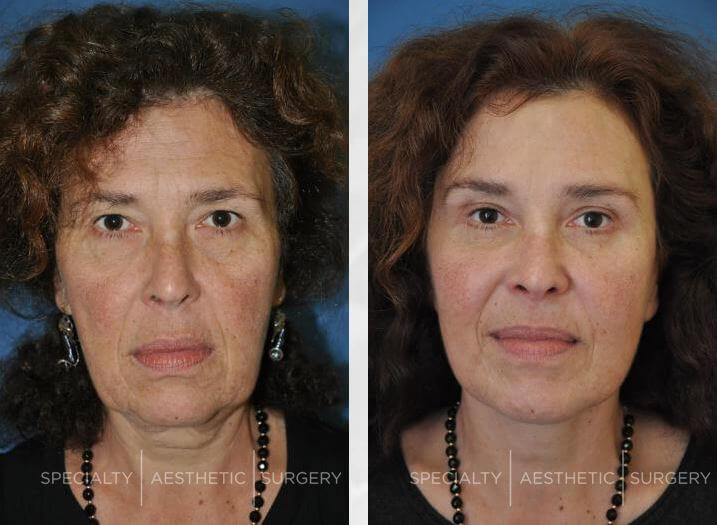Facial Cosmetic Surgery Manhattan