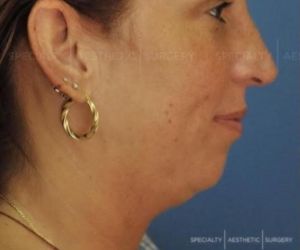 Neck Lift Manhattan NYC