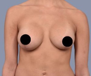 Breast Lift_B&A - 1