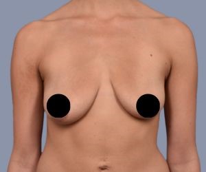 Breast Lift_B&A - 1