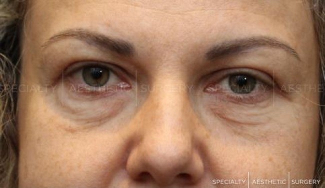 Blepharoplasty