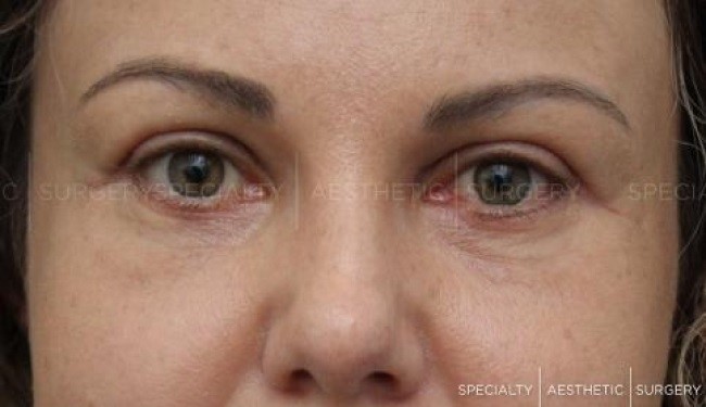 Blepharoplasty