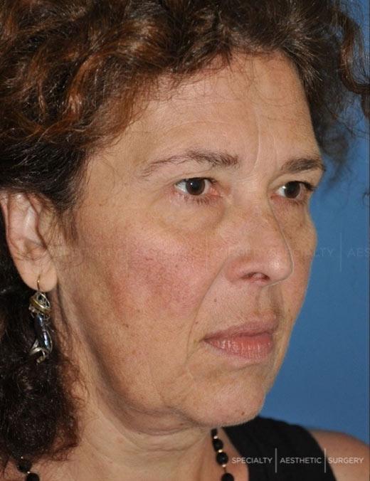 Scarless Facelift Manhattan & NYC