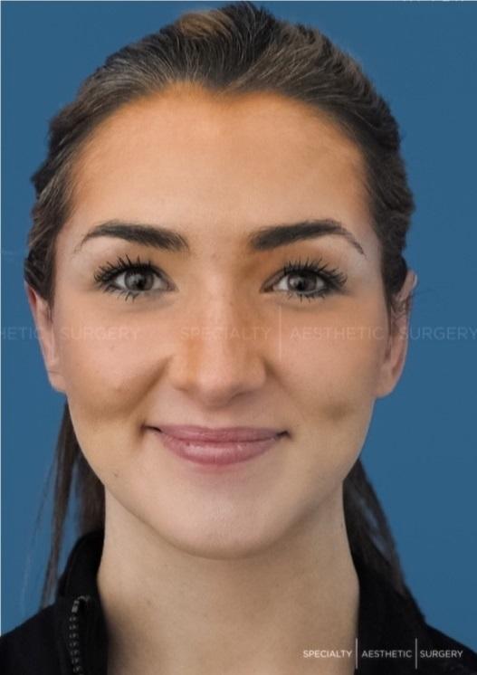 Otoplasty Manhattan & NYC