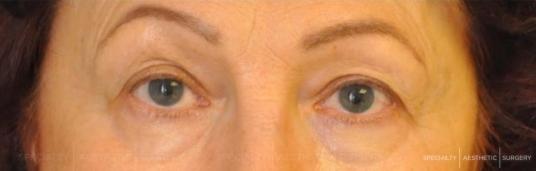 Blepharoplasty Manhattan & NYC