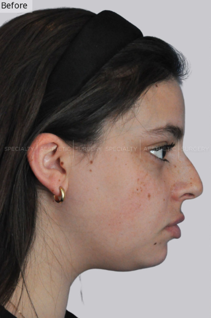 Case-3412-Face-Rhinoplasty-Specialty-Aesthetic-Surgery-Gallery-Specialty-Aesthetic-Surgery-05-21-2025_06_58_PM