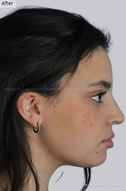 Case-3412-Face-Rhinoplasty-Specialty-Aesthetic-Surgery-Gallery-Specialty-Aesthetic-Surgery-05-21-2025_07_00_PM