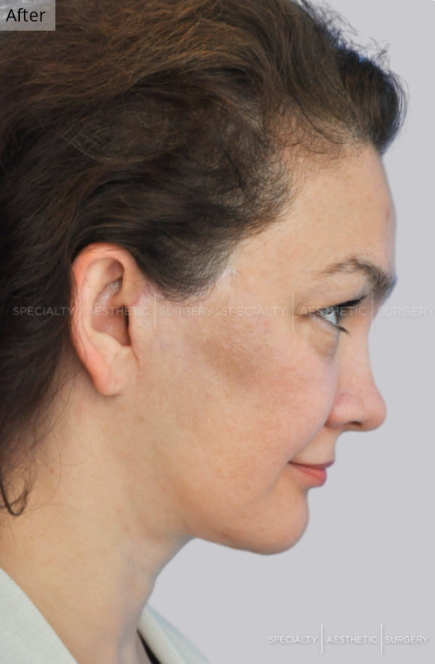 Facelift, Blepharoplasty, Fat Transfer, Manhattan & NYC