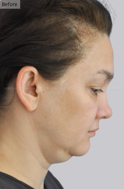 Facelift, Blepharoplasty, Fat Transfer, Manhattan & NYC