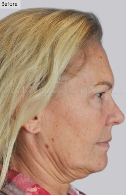 Dermal Fillers, Microneedling, CO2 Laser, Manhattan & NYC