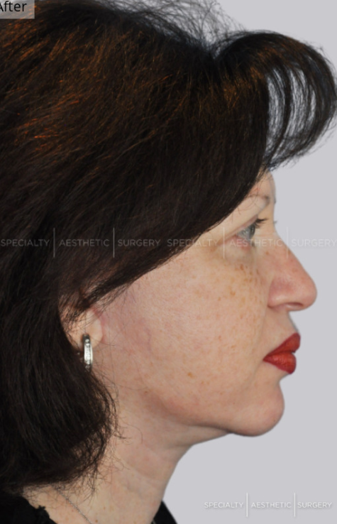 Facelift, Neck Lift, Manhattan & NYC