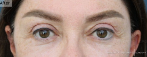 Blepharoplasty, Brow Lift, Manhattan & NYC