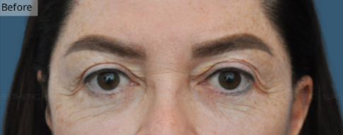 Blepharoplasty, Brow Lift, Manhattan & NYC