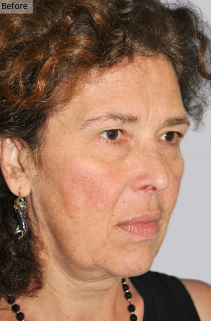 Facelift, Mini Facelift, Manhattan & NYC