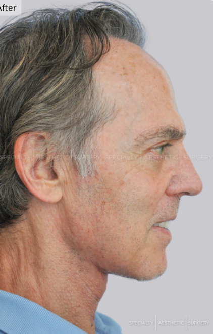 Facelift, Neck Lift, Manhattan & NYC