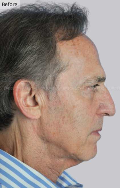 Facelift, Neck Lift, Manhattan & NYC